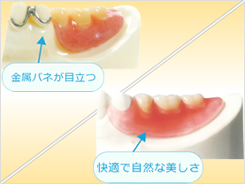 ノンメタルクラスプデンチャー